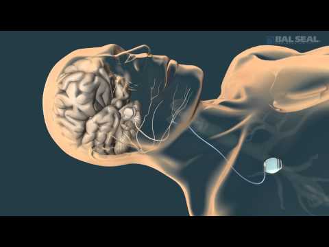 SYGNUS® Implantable Contact System