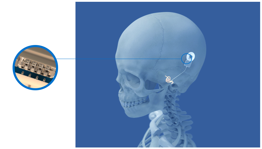 Balseal Medical Devices Cochlear Implant