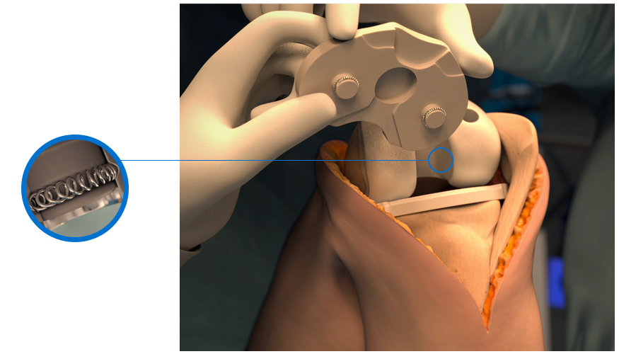 Balseal Medical Devices Knee Joint Tibial Trials