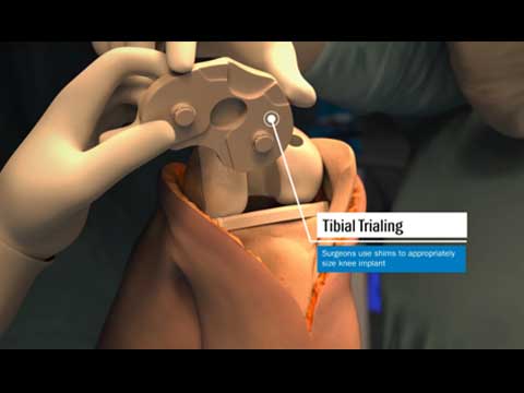 Bal Spring Latching in Radiolucent Retractor