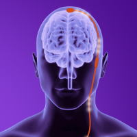 neuromodulation device slideshare image
