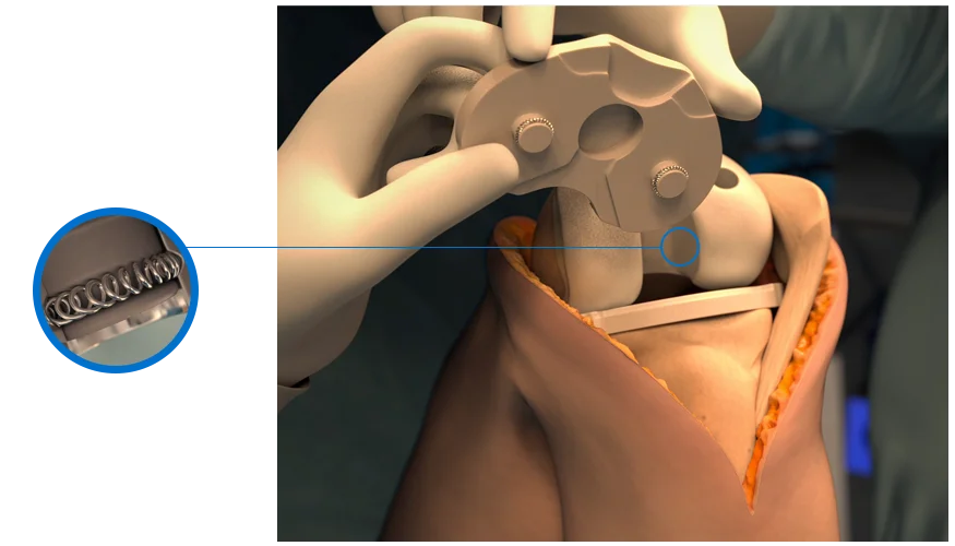 Bal Seal Medical Devices Knee Joint Tibial Trials