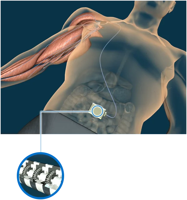 Sygnus medical implantable