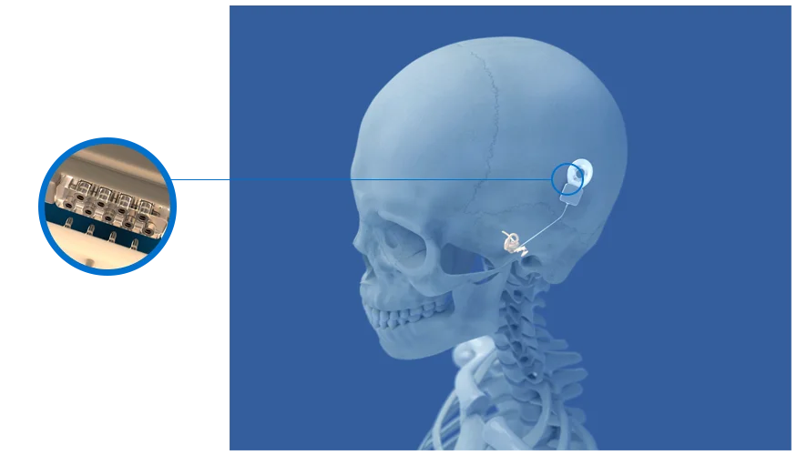 Bal Seal Medical Devices Cochlear Implant
